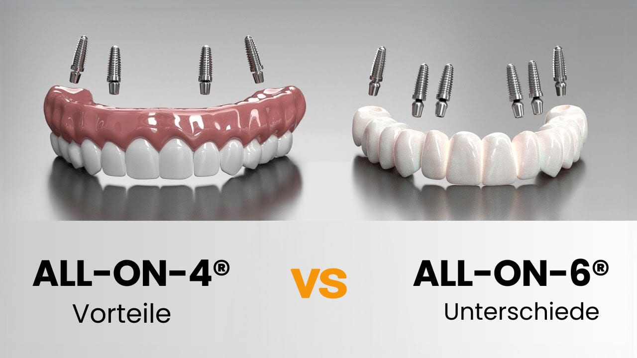 All-on-4-vs-All-on-6