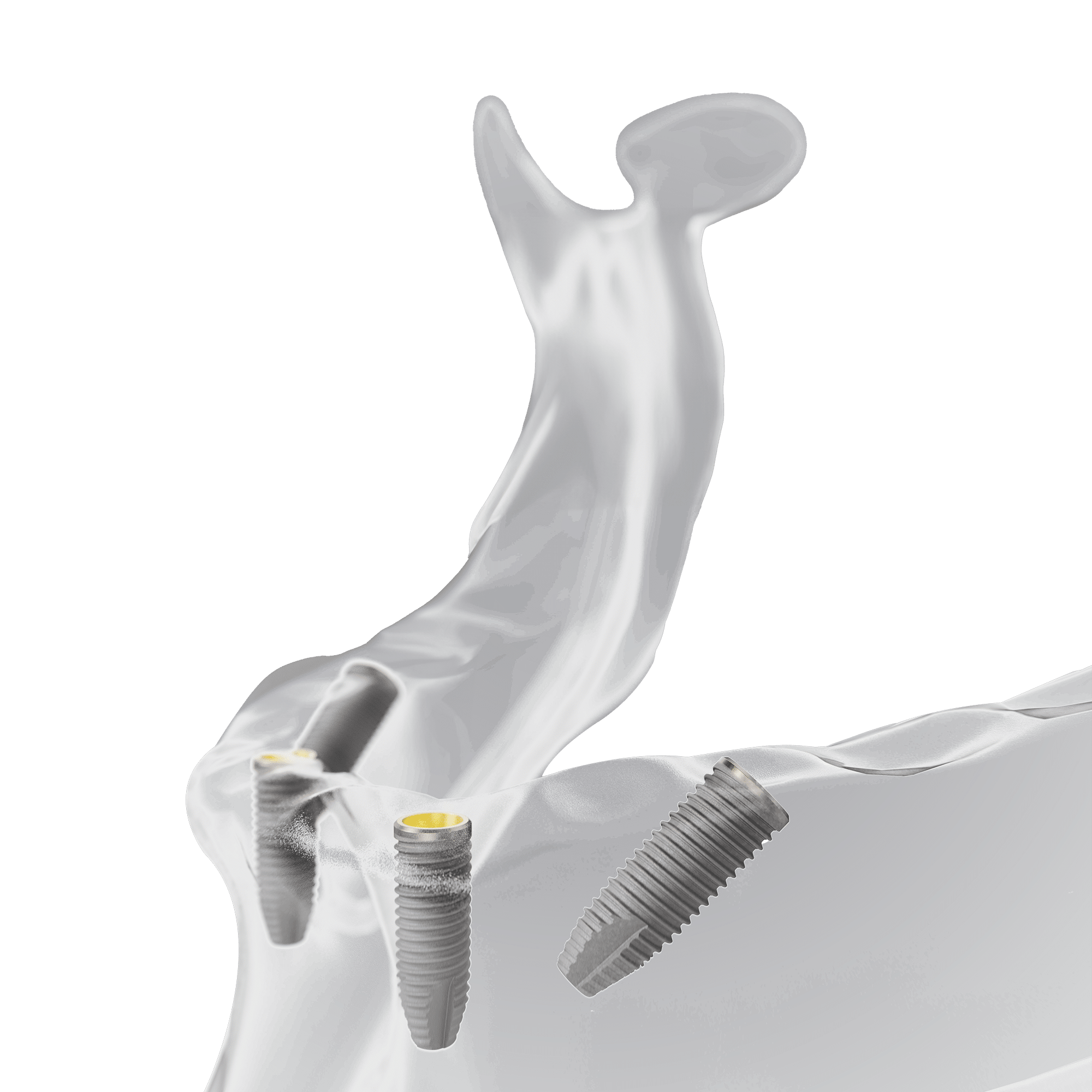 Implantate setzen 2